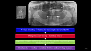 56/60
Cortical boundary of the maxilla including the posterior border
Pterygomaxillary fissure – maxillary sinuses
Zygomatic complex (inferior and lateral borders of orbit, zygomatic process,
anterior portion of arch)
Nasal cavity --- conchae – Maxillary dentition and supporting alveolus
 