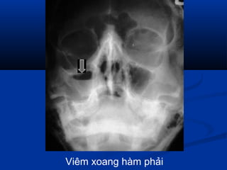 Viêm xoang hàm phải
 