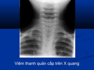 Viêm thanh quản cấp trên X quang
 