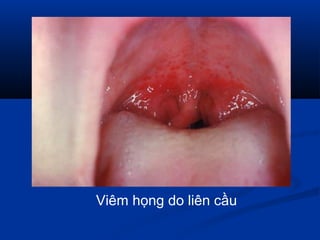 Viêm họng do liên cầu
 