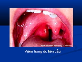 Viêm họng do liên cầu
 