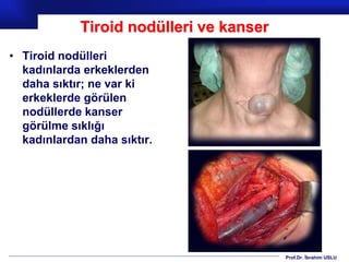 Prof.Dr. İbrahim USLU
Tiroid nodülleri ve kanser
• Tiroid nodülleri
kadınlarda erkeklerden
daha sıktır; ne var ki
erkeklerde görülen
nodüllerde kanser
görülme sıklığı
kadınlardan daha sıktır.
 