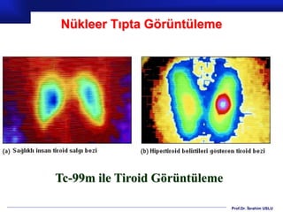 Prof.Dr. İbrahim USLU
Nükleer Tıpta Görüntüleme
Tc-99m ile Tiroid Görüntüleme
 