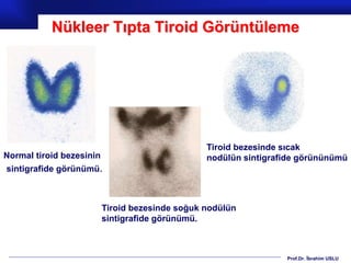 Prof.Dr. İbrahim USLU
Nükleer Tıpta Tiroid Görüntüleme
Normal tiroid bezesinin
sintigrafide görünümü.
Tiroid bezesinde soğuk nodülün
sintigrafide görünümü.
Tiroid bezesinde sıcak
nodülün sintigrafide görününümü
 