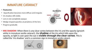 immature senile cataract iris shadow Images High... NKT Sir Class CRAO CATARACT ET AL....pptx