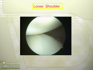 Loose Shoulder
 