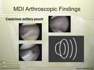 MDI Arthroscopic Findings
Capacious axillary pouch
www.shoulder.gr
 