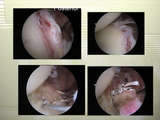 Posterior Instability
 
