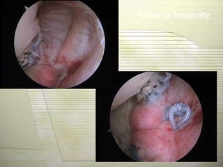 Posterior Instability
 