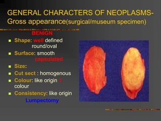GENERAL CHARACTERS OF NEOPLASMS-
Gross appearance(surgical/museum specimen)
BENIGN
 Shape: well defined
round/oval
 Surface: smooth
capsulated
 Size:
 Cut sect : homogenous
 Colour: like origin 1
colour
 Consistency: like origin
Lumpectomy
 