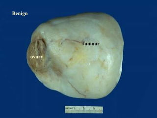 Benign
ovary
Tumour
 