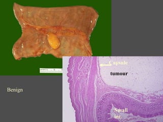 Benign
tumour
Small
int.
Capsule
 