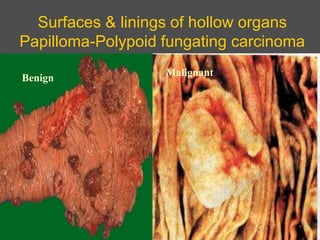 Surfaces & linings of hollow organs
Papilloma-Polypoid fungating carcinoma
BENIGN MALIGNANT

Benign
Malignant
 