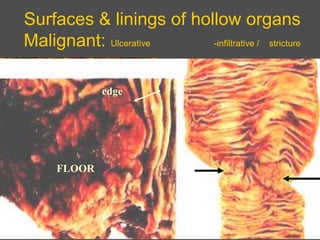 Surfaces & linings of hollow organs
Malignant: Ulcerative -infiltrative / stricture
FLOOR
edge
 