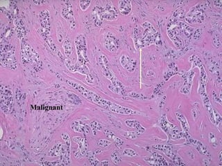 Malignant
 