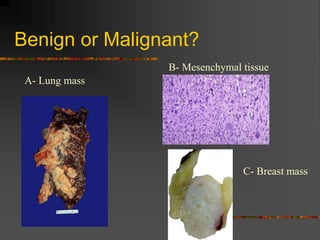 Benign or Malignant?
A- Lung mass
B- Mesenchymal tissue
C- Breast mass
 