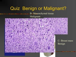 Quiz Benign or Malignant?
A- Lung mass
Malignant
B- Mesenchymal tissue
Malignant
C- Breast mass
Benign
 