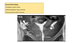 Hsg Image Normal Inverted NLHP 18.5 Tubal Patency by Hystero Salpingography (HSG)..pdf