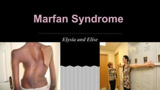 Marfan Syndrome
Elysia and Elise
 