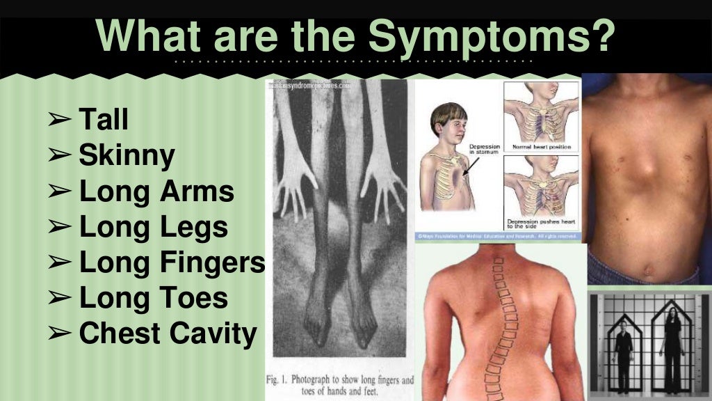 Marfan syndrome