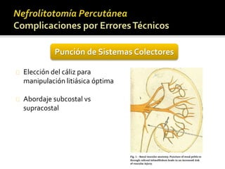 Punción de Sistemas Colectores 
Elección del cáliz para 
manipulación litiásica óptima 
Abordaje subcostal vs 
supracostal 
 