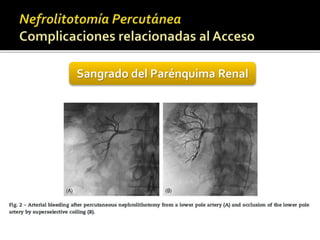 Sangrado del Parénquima Renal 
 