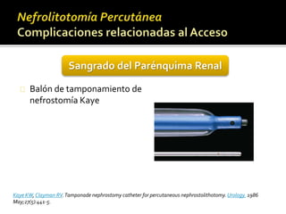 Sangrado del Parénquima Renal 
Balón de tamponamiento de 
nefrostomía Kaye 
Kaye KW, Clayman RV. Tamponade nephrostomy catheter for percutaneous nephrostolithotomy. Urology. 1986 
May;27(5):441-5. 
 