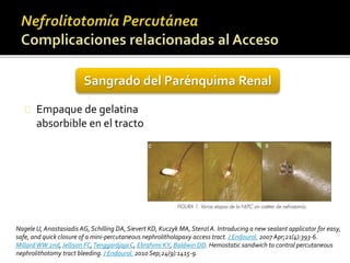 Sangrado del Parénquima Renal 
Empaque de gelatina 
absorbible en el tracto 
Nagele U, Anastasiadis AG, Schilling DA, Sievert KD, Kuczyk MA, Stenzl A. Introducing a new sealant applicator for easy, 
safe, and quick closure of a mini-percutaneous nephrolitholapaxy access tract. J Endourol. 2007 Apr;21(4):393-6. 
MillardWW 2nd, Jellison FC, Tenggardjaja C, Ebrahimi KY, Baldwin DD. Hemostatic sandwich to control percutaneous 
nephrolithotomy tract bleeding. J Endourol. 2010 Sep;24(9):1415-9. 
 