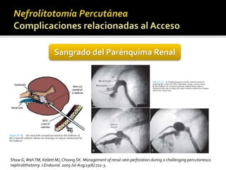 Sangrado del Parénquima Renal 
Shaw G, WahTM, KellettMJ, Choong SK. Management of renal-vein perforation during a challenging percutaneous 
nephrolithotomy. J Endourol. 2005 Jul-Aug;19(6):722-3. 
 