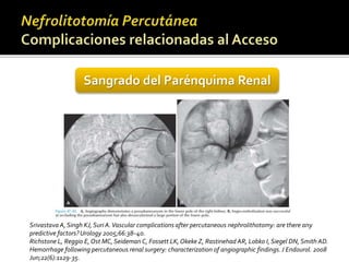 Sangrado del Parénquima Renal 
Srivastava A, Singh KJ, Suri A. Vascular complications after percutaneous nephrolithotomy: are there any 
predictive factors? Urology 2005;66:38–40. 
Richstone L, Reggio E, OstMC, Seideman C, Fossett LK, Okeke Z, Rastinehad AR, Lobko I, Siegel DN, Smith AD. 
Hemorrhage following percutaneous renal surgery: characterization of angiographic findings. J Endourol. 2008 
Jun;22(6):1129-35. 
 
