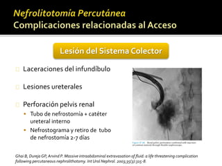 Lesión del Sistema Colector 
Laceraciones del infundíbulo 
Lesiones ureterales 
Perforación pelvis renal 
 Tubo de nefrostomía + catéter 
ureteral interno 
 Nefrostograma y retiro de tubo 
de nefrostomía 2-7 días 
Ghai B, DurejaGP, Arvind P. Massive intraabdominal extravasation of fluid: a life threatening complication 
following percutaneous nephrolithotomy. IntUrol Nephrol. 2003;35(3):315-8. 
 