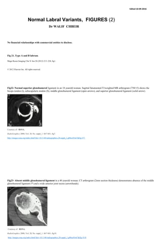 Edited 10-09-2016
Normal Labral Variants, FIGURES (2)
Dr WALIF CHBEIR
No financial relationships with commercial entities to disclose.
Fig 21. Type A and B labrum.
Magn Reson Imaging Clin N Am 20 (2012) 213–228; fig1.
© 2012 Elsevier Inc. All rights reserved.
Fig22- Normal superior glenohumeral ligament in an 18 yearold woman. Sagittal fatsaturated T1weighted MR arthrogram (750/15) shows the
biceps tendon (t), subscapularis tendon (S), middle glenohumeral ligament (open arrows), and superior glenohumeral ligament (solid arrow).
Courtesy of: RSNA.
RadioGraphics 2000, Vol. 20, No. suppl_1: S67-S81; fig7.
http://images.rsna.org/index.html?doi=10.1148/radiographics.20.suppl_1.g00oc03s67&fig=F7.
Fig23- Absent middle glenohumeral ligament in a 40 yearold woman. CT arthrogram (2mm section thickness) demonstrates absence of the middle
glenohumeral ligament (*) and a wide anterior joint recess (arrowheads).
Courtesy of : RSNA.
RadioGraphics 2000, Vol. 20, No. suppl_1: S67-S81; fig10.
http://images.rsna.org/index.html?doi=10.1148/radiographics.20.suppl_1.g00oc03s67&fig=F10
 