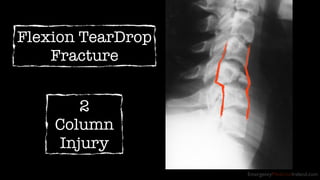 EmergencyMedicineIreland.com 
Flexion TearDrop 
Fracture 
2 
Column 
Injury 
 