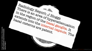 EmergencyMedicineIreland.com 
Radiology Report: J Bloggs 
There is an area of hyperattenuation 
in the region of the basal...