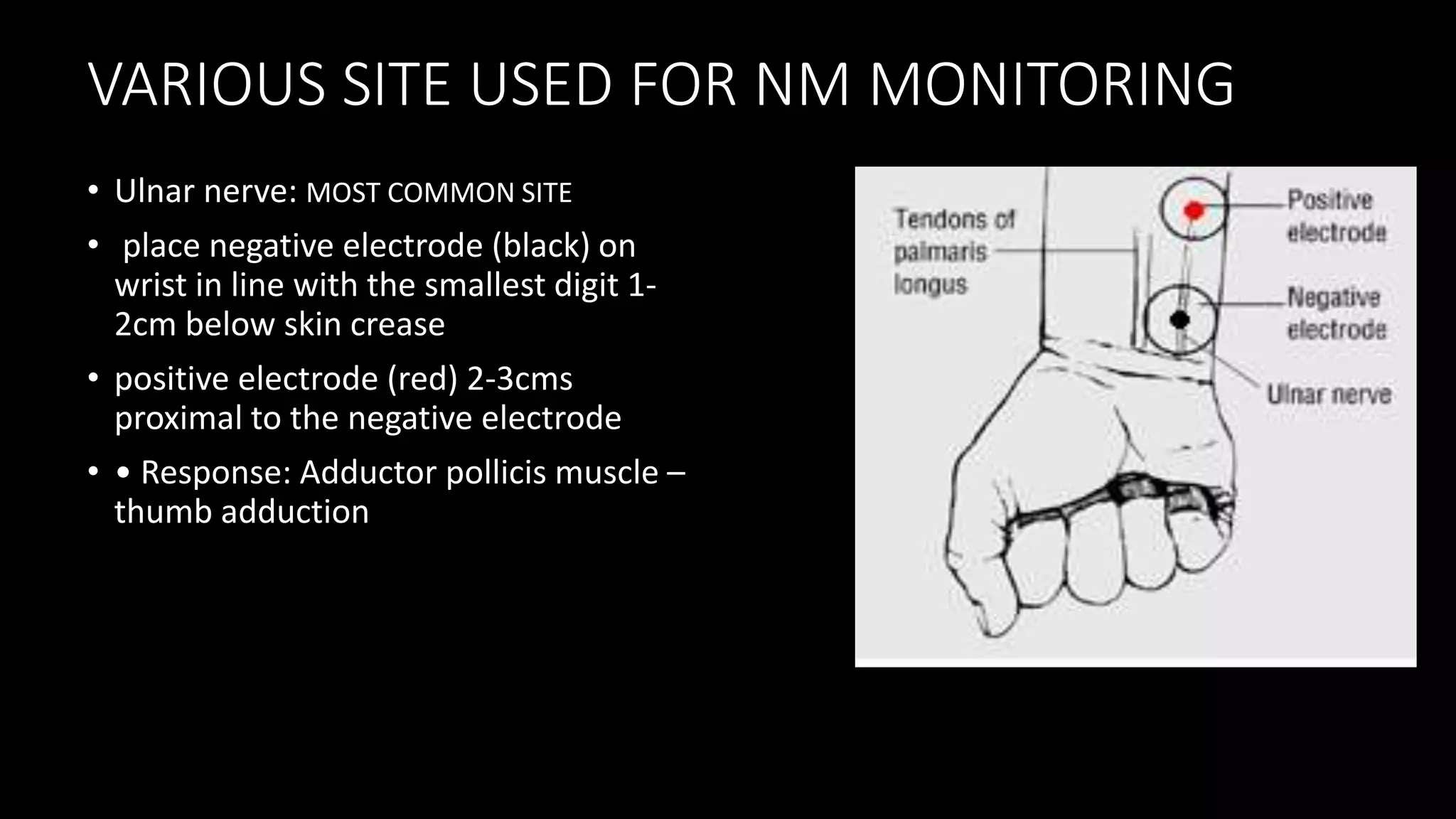 • Ulnar nerve: MOST COMMON SITE
• place negative electrode (black) on
wrist in line with the smallest digit 1-
2cm below skin crease
• positive electrode (red) 2-3cms
proximal to the negative electrode
• • Response: Adductor pollicis muscle –
thumb adduction
VARIOUS SITE USED FOR NM MONITORING
 