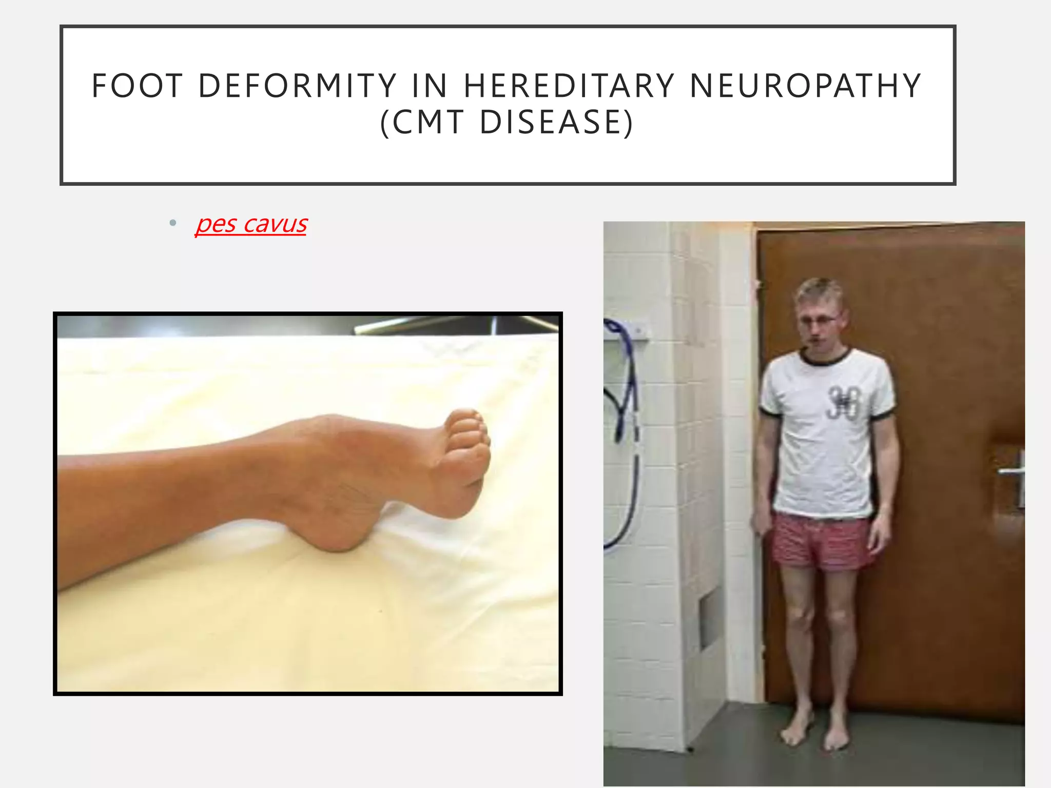 FOOT DEFORMITY IN HEREDITARY NEUROPATHY
(CMT DISEASE)
• pes cavus
 