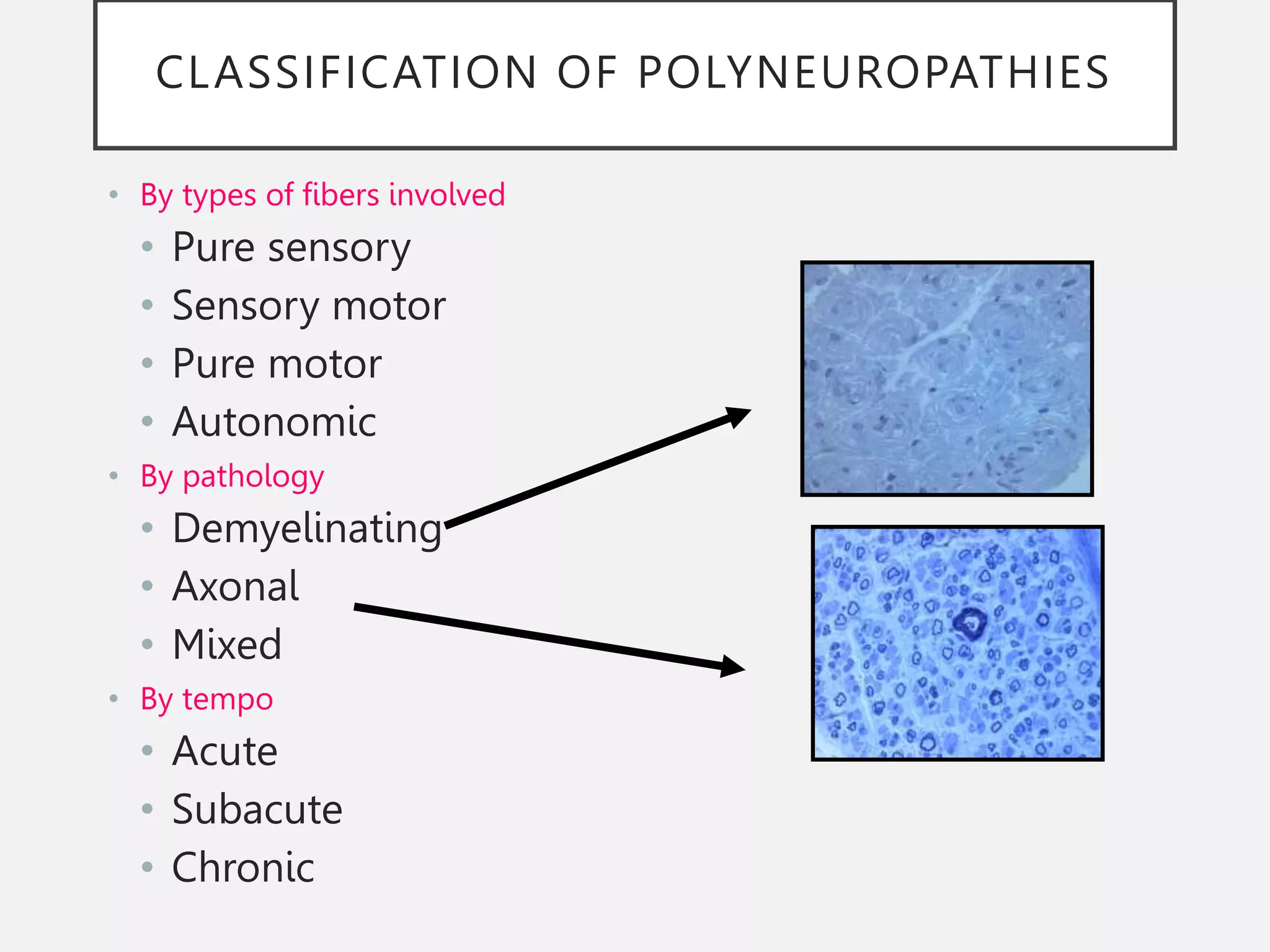 CLASSIFICATION OF POLYNEUROPATHIES
• By types of fibers involved
• Pure sensory
• Sensory motor
• Pure motor
• Autonomic
• By pathology
• Demyelinating
• Axonal
• Mixed
• By tempo
• Acute
• Subacute
• Chronic
 