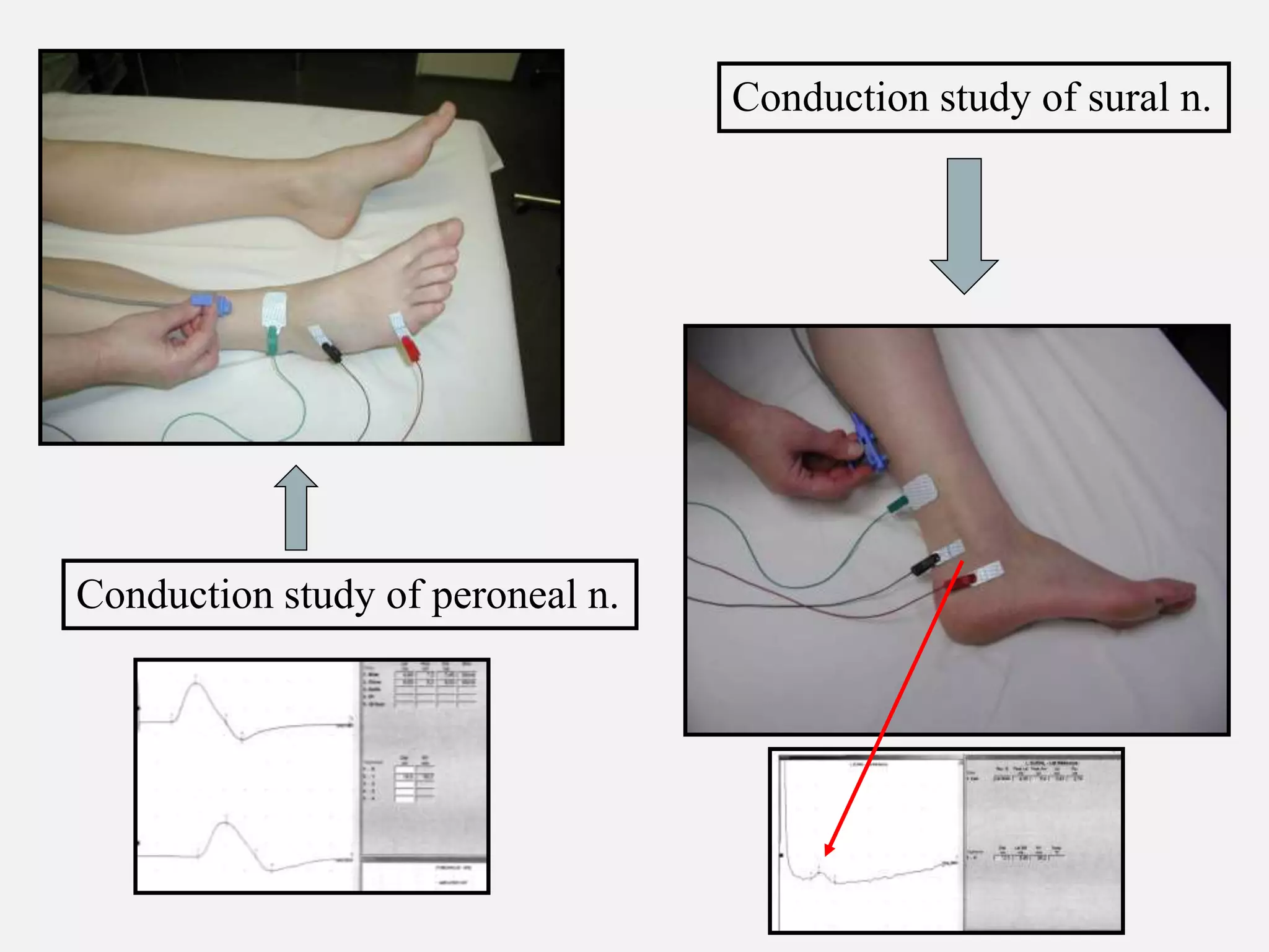 Conduction study of peroneal n.
Conduction study of sural n.
 