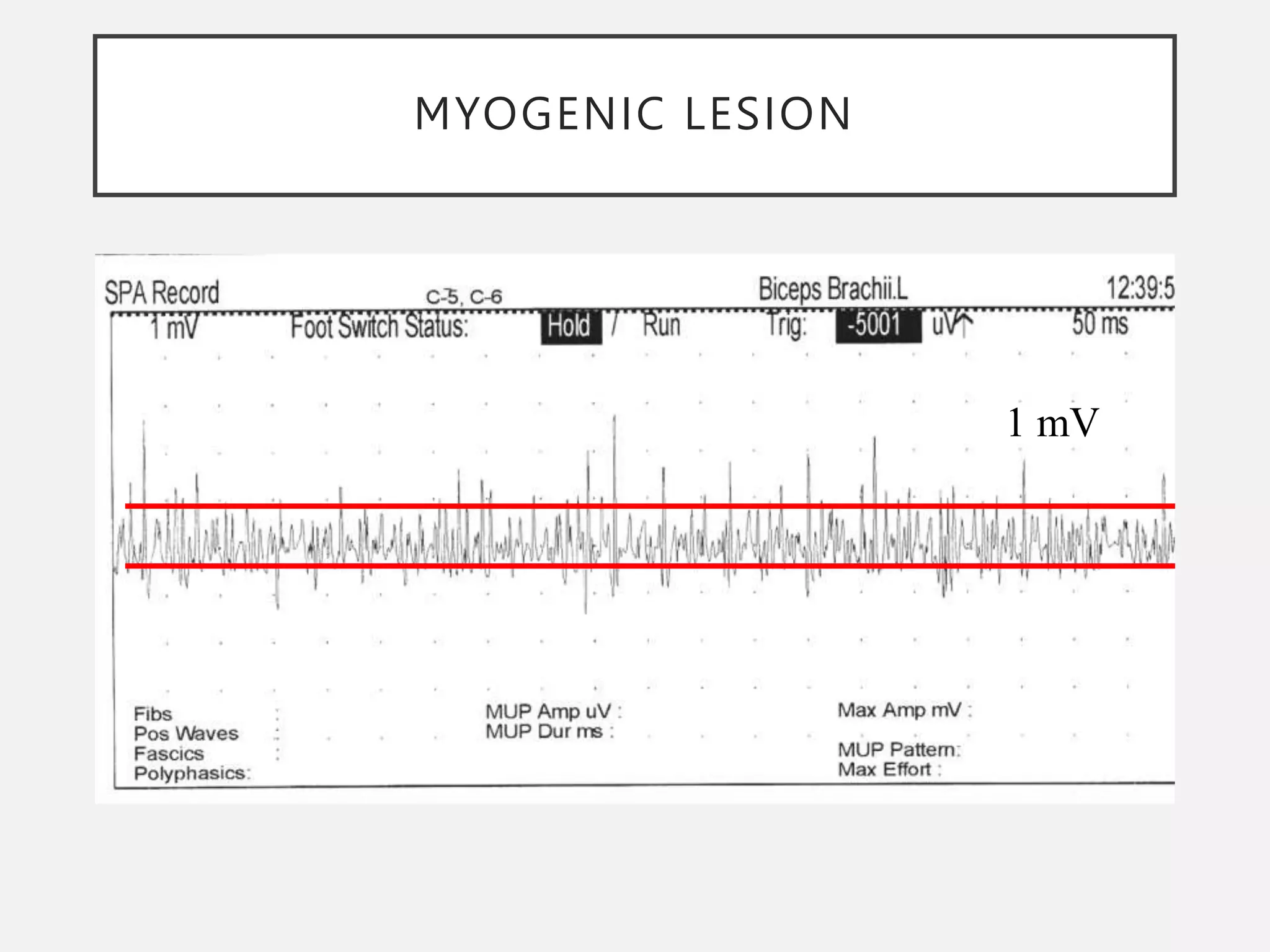 MYOGENIC LESION
1 mV
 