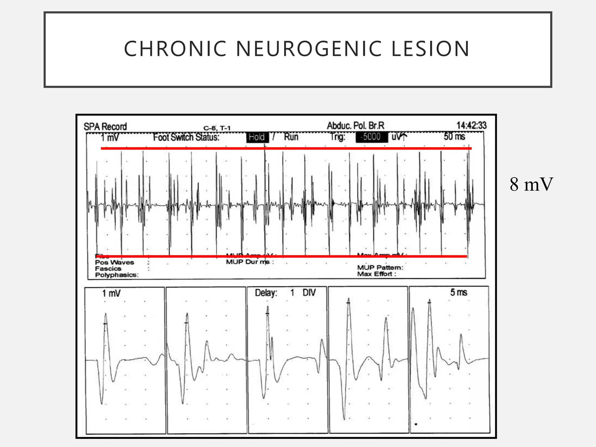 CHRONIC NEUROGENIC LESION
8 mV
 