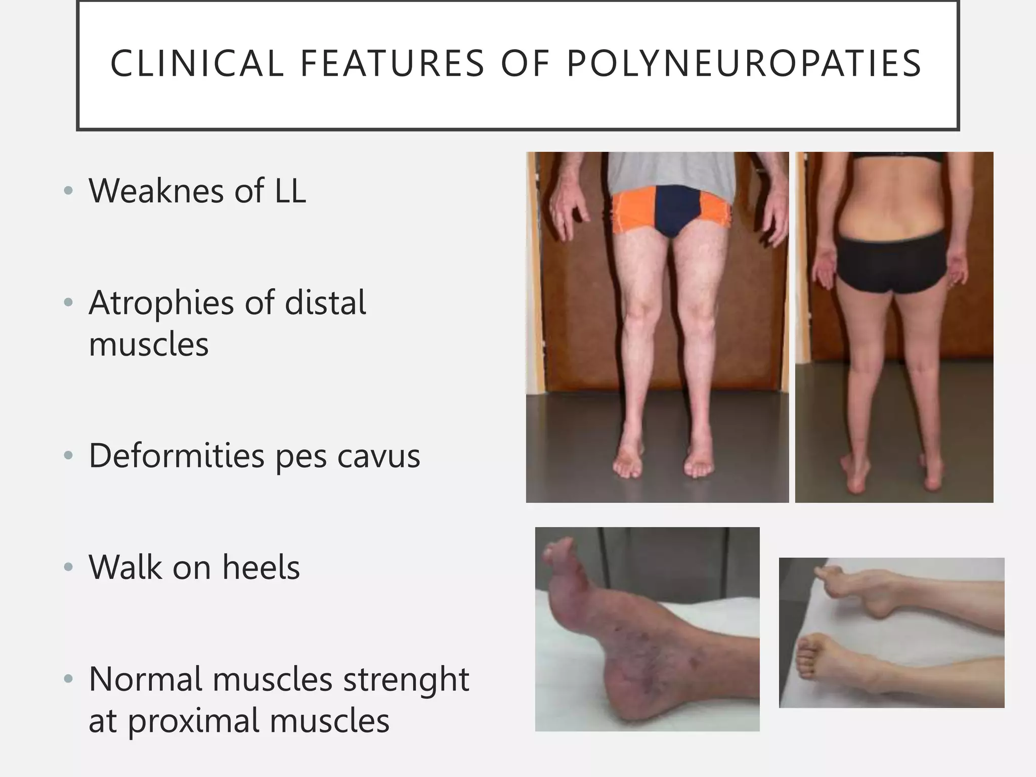 CLINICAL FEATURES OF POLYNEUROPATIES
• Weaknes of LL
• Atrophies of distal
muscles
• Deformities pes cavus
• Walk on heels
• Normal muscles strenght
at proximal muscles
 