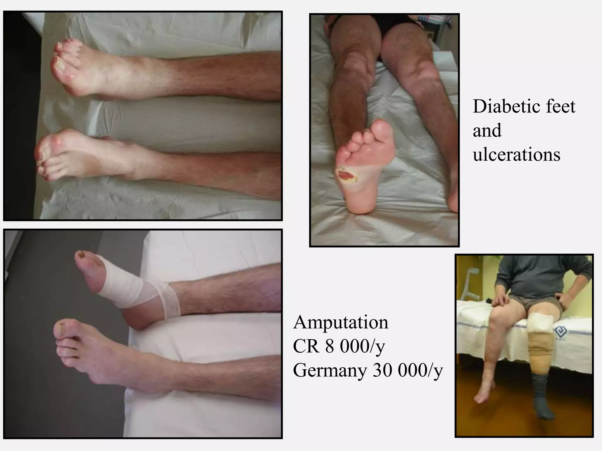 Diabetic feet
and
ulcerations
Amputation
CR 8 000/y
Germany 30 000/y
 