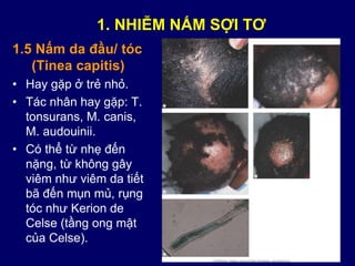 1.5 Nấm da đầu/ tóc
(Tinea capitis)
• Hay gặp ở trẻ nhỏ.
• Tác nhân hay gặp: T.
tonsurans, M. canis,
M. audouinii.
• Có thể từ nhẹ đến
nặng, từ không gây
viêm như viêm da tiết
bã đến mụn mủ, rụng
tóc như Kerion de
Celse (tầng ong mật
của Celse).
1. NHIỄM NẤM SỢI TƠ
 