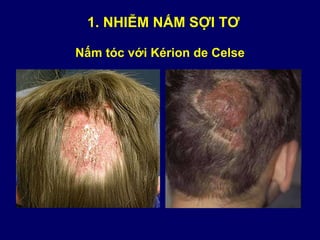 Nấm tóc với Kérion de Celse
1. NHIỄM NẤM SỢI TƠ
 