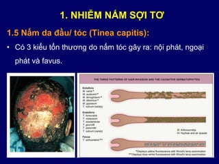 1.5 Nấm da đầu/ tóc (Tinea capitis):
• Có 3 kiểu tổn thương do nấm tóc gây ra: nội phát, ngoại
phát và favus.
1. NHIỄM NẤM SỢI TƠ
 