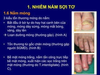 1.6 Nấm móng
3 kiểu tổn thương móng do nấm:
• Bắt đầu ở bờ tự do hay hai canh bên của
móng, móng dày sừng, móng mất bóng,
vàng, dày lên
 Loạn dưỡng móng (thường gặp). (hình A)
• Tổn thương từ gốc chân móng (thường gặp
người SGMD). (hình B)
• Bề mặt móng trắng, nấm tấn công trực tiếp
bề mặt móng, xuất hiện các sọc trắng trên
mặt móng (thường do T.interdigitale). (hình
C).
1. NHIỄM NẤM SỢI TƠ
 