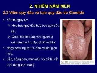 • Yếu tố nguy cơ:
 Hẹp bao quy đầu hay bao quy đầu
dài.
 Quan hệ tình dục với người bị
viêm âm hộ âm đạo do Candida.
• Nhạy cảm, ngứa; +/- đau rát khi giao
hợp.
• Sẩn, hồng ban, mụn mủ, vỡ để lại vết
trợt, đóng bợn trắng.
2.3 Viêm quy đầu và bao quy đầu do Candida
2. NHIỄM NẤM MEN
 