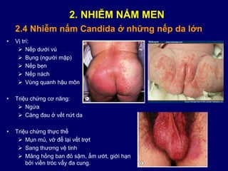 • Vị trí:
 Nếp dưới vú
 Bụng (người mập)
 Nếp bẹn
 Nếp nách
 Vùng quanh hậu môn
• Triệu chứng cơ năng:
 Ngứa
 Căng đau ở vết nứt da
• Triệu chứng thực thể
 Mụn mủ, vỡ để lại vết trợt
 Sang thương vệ tinh
 Mảng hồng ban đỏ sậm, ẩm ướt, giới hạn
bởi viền tróc vẩy đa cung.
2.4 Nhiễm nấm Candida ở những nếp da lớn
2. NHIỄM NẤM MEN
 