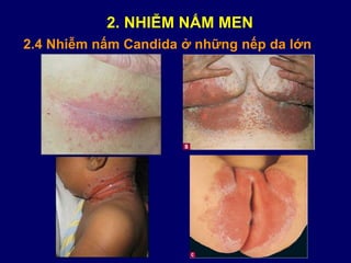 2.4 Nhiễm nấm Candida ở những nếp da lớn
2. NHIỄM NẤM MEN
 