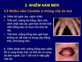 a. Viêm kẽ ngón tay, ngón chân
• Thể ướt: mảng da trắng, tẩm ướt,
dính chặt vào da, giới hạn rõ bỏi một
viền hồng ban có mụn mủ nhỏ rải
rác.
• Thể khô: mảng hồng ban giới hạn
không rõ, bề mặt có bong vảy trắng
khô, khó bong tróc.
b. Viêm khóe môi: mảng hồng ban viêm
đỏ ở vùng khóe môi, có thể lan ra vùng
da bên ngoài. Có 1 vết nứt ở nếp gấp
của da.
2.5 Nhiễm nấm Candida ở những nếp da nhỏ
2. NHIỄM NẤM MEN
 